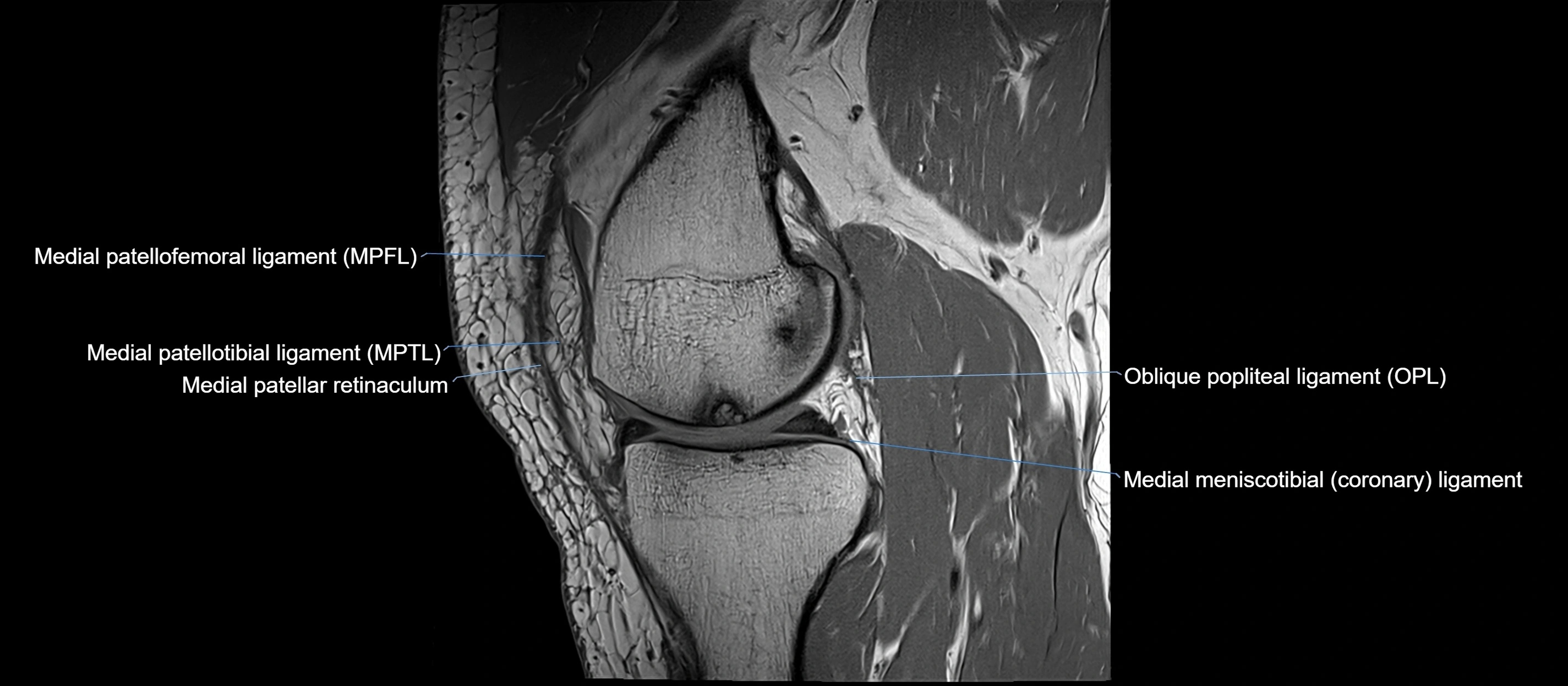 MRI sagittal  ligaments cross sectional anatomy 3T  radiology  image-img-00001-00019.webp